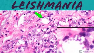 Leishmaniasis Leishmania Infection 5Minute Pathology Pearls ‪Dermatology Dermatopathology [upl. by Innej750]