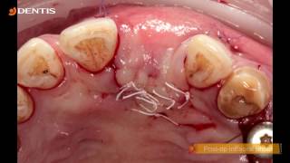 DENTIS Implant Implant Placement with GBR Procedure [upl. by Brita]