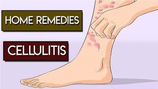 Home Remedies for Cellulitis Skin Infection [upl. by Anilehs245]