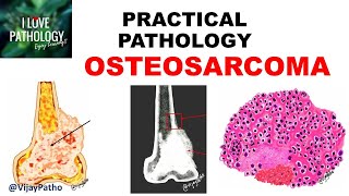 Osteosarcoma  Pathology Symptoms Diagnosis Treatment [upl. by Nalehp281]