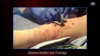 WCW Abscess Incision and Drainage [upl. by Aprilette86]