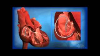 Ablation for AV Node Reentrant Tachycardia AVNRT [upl. by Ibbed]