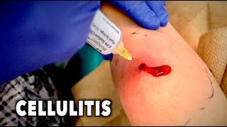 ABSCESS WITH CELLULITIS We had to drain it  Dr Paul [upl. by Selmner575]