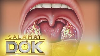 Salamat Dok Information about tonsil stones [upl. by Tewell544]