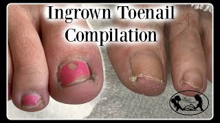 Satisfying Ingrown Toenail Pedicure Compilation [upl. by Beitch]