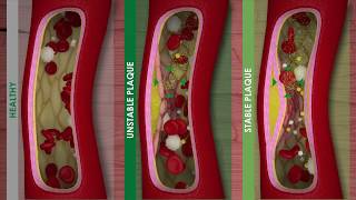 Pathogenesis of Atherosclerosis [upl. by Dorsy]