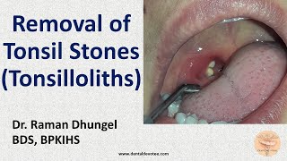 Tonsil Stone Removal  Tonsillolith removal by Dr Raman Dhungel [upl. by Sybille740]