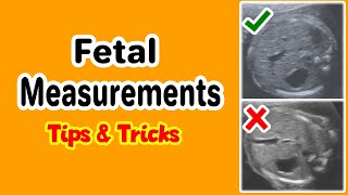 Fetal Distress Ultrasound and Heart Monitor [upl. by Chalmers]