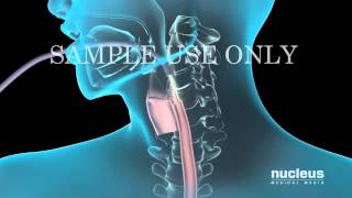 Upper Gastrointestinal Endoscopy EGD [upl. by Riebling59]