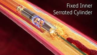 Atherosclerosis in 2 minutes [upl. by Aigroeg]