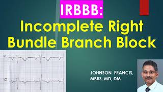 IRBBB Incomplete Right Bundle Branch Block [upl. by Fonseca]