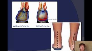 Plantar Fasciitis explained by a Podiatrist [upl. by Eeluj]