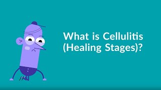 Cellulitis Healing Stages [upl. by Samson]