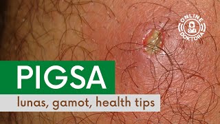 PIGSA Lunas Gamot at Health Tips  Anong Dapat Gawin Kapag May Pigsa o Boil [upl. by Fagin]