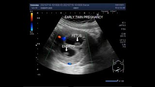 Early first trimester twin Pregnancy  08 weeks [upl. by Mott]