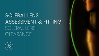 Scleral and Hybrid Lens Insertion with the S5 Lens Insertion System™ [upl. by Snahc]