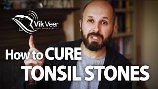 How to Cure Tonsil Stones [upl. by Neibaf]