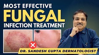 Effective Fungal Infection Treatment By Dermatologist  Dr SANDESH GUPTA 9990804089 [upl. by Marla45]