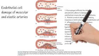 Development of atherosclerosis [upl. by Tallbott]