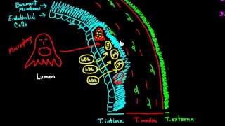 ATHEROSCLEROSIS Part 3  Morphology and consequences [upl. by Fitting445]