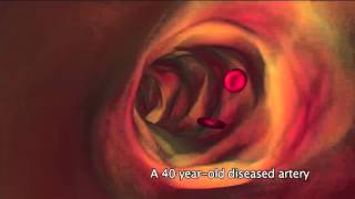 Ultrasound of Abdominal Aortic Aneurysm AAA [upl. by Laicram78]