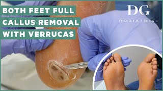 Callus removal from feet both feet and three verruca plantar warts treatment [upl. by Reger532]