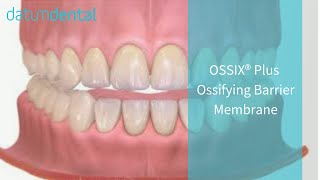 OSSIX PLUS Resorbable Collagen Dental Membrane 2014 [upl. by Card]