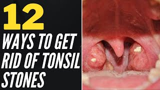 12 Ways To Get Rid Of Tonsil Stones At Home [upl. by Baptista]