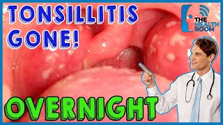 10 Effective Tonsillitis Home Remedies That Work Fast [upl. by Budde]