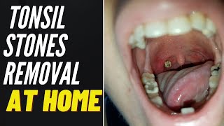 TONSIL STONE REMOVAL At Home 2021 [upl. by Rabiah]