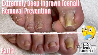 Salon Pedicure Ingrown Toenail Removal Prevention Transformation Part 1 [upl. by Castle919]