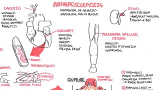 Atherosclerosis  Pathophysiology [upl. by Hayashi]