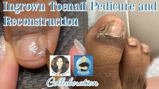 Pedicure with Toenail Reconstruction After Ingrown Toenail Removal with The Toe Bro [upl. by Eerdua]