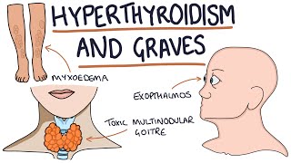 Understanding Hyperthyroidism and Graves Disease [upl. by Jefferson]