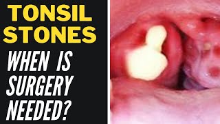 Tonsil Stone Home Remedies When Surgery Is Needed [upl. by Illom480]