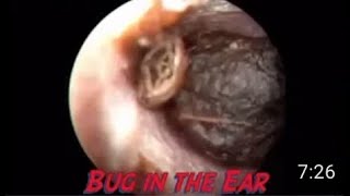 Insect inside the ear [upl. by Whitelaw]