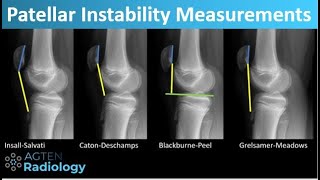 Patellar Instability  What and How to Measure [upl. by Suhail440]