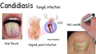 ORAL THRUSH  Candidiasis or yeast infection Angular cheilitis © [upl. by Amleht]