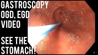 upper gastrointestinal endoscopy procedure [upl. by Niawat]