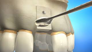 Bone Grafting Procedure Video Animation  Durham Dental Solutions [upl. by Zacharia]