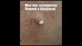 Grote meeeter verwijderen  Remove a big blackhead [upl. by Chelsea46]