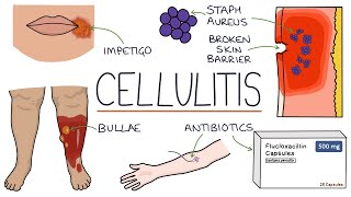 Understanding Cellulitis Skin and Soft Tissue Infections [upl. by Tarrant]