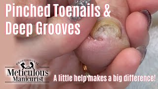 Pedicure Thick Pinched Toenails Satisfying Before and After [upl. by Andromache]