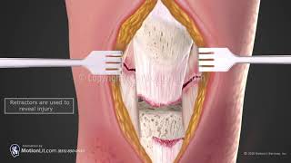 Patella Tendon Repair [upl. by Ennovihc]