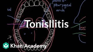 Tonsillitis  Respiratory system diseases  NCLEXRN  Khan Academy [upl. by Kinsley528]