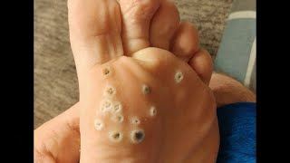 Plantar Wart Removal How to Remove Plantar Warts [upl. by Hanway739]