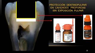 Protección dentino Pulpara Principios de la Adhesion [upl. by Notyrb]