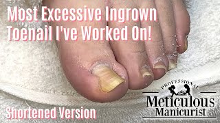 Most Extreme Ingrown Toenail Salon Pedicure  Shortened [upl. by Acined]