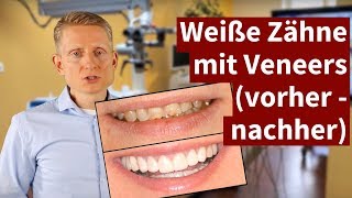 Weiße Zähne mit Veneers vorher  nachher 2021 [upl. by Uokes328]