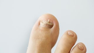 How to prevent and treat nail fungus [upl. by Asiuqram189]